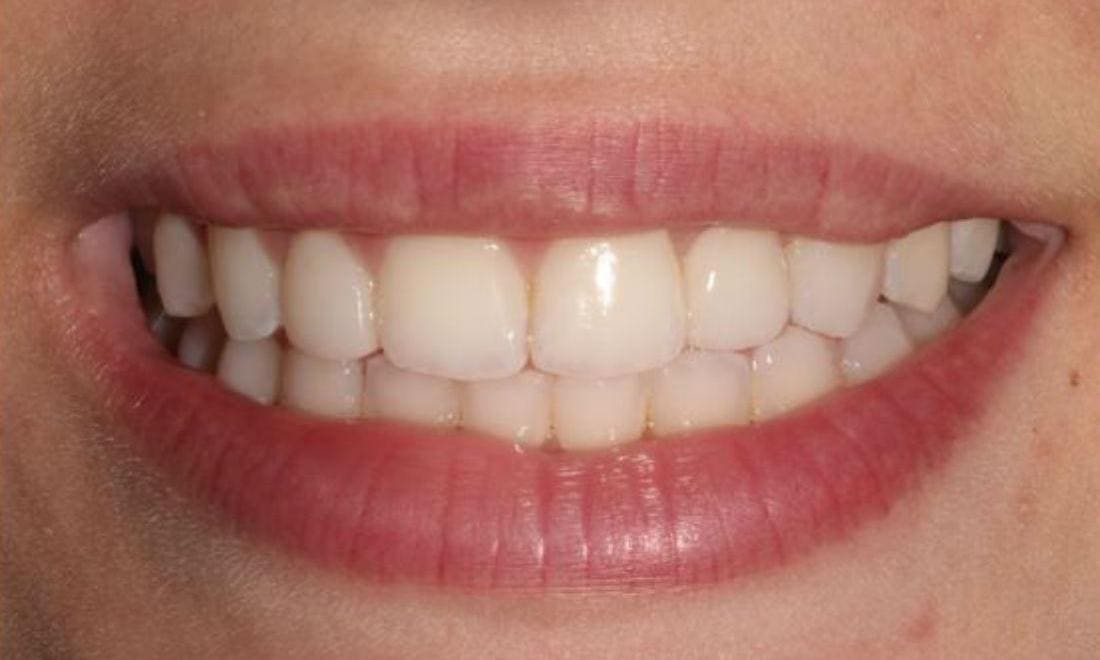 Close-up after: the gap filled by a porcelain bridge and the small tooth bonded to full size, all teeth whiter