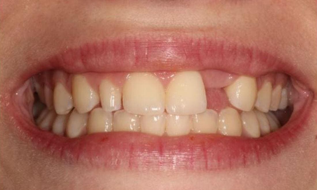Close-up before: a gap where an upper side tooth is missing, and a small peg-shaped tooth on the other side
