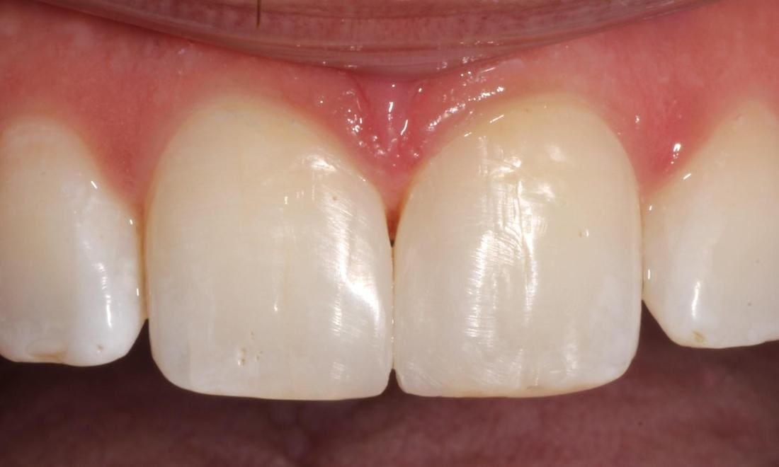 Close-up after: the same front teeth with smooth, even edges rebuilt in composite bonding