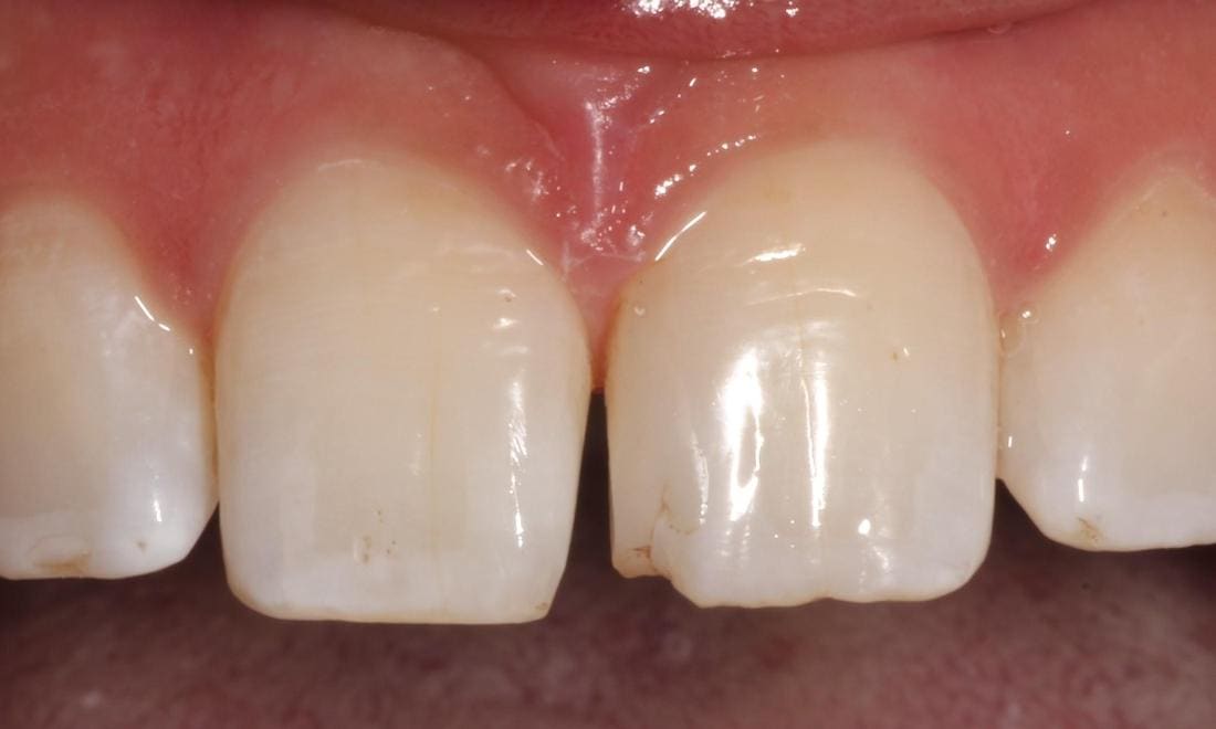 Close-up before: two upper front teeth with chipped, uneven edges