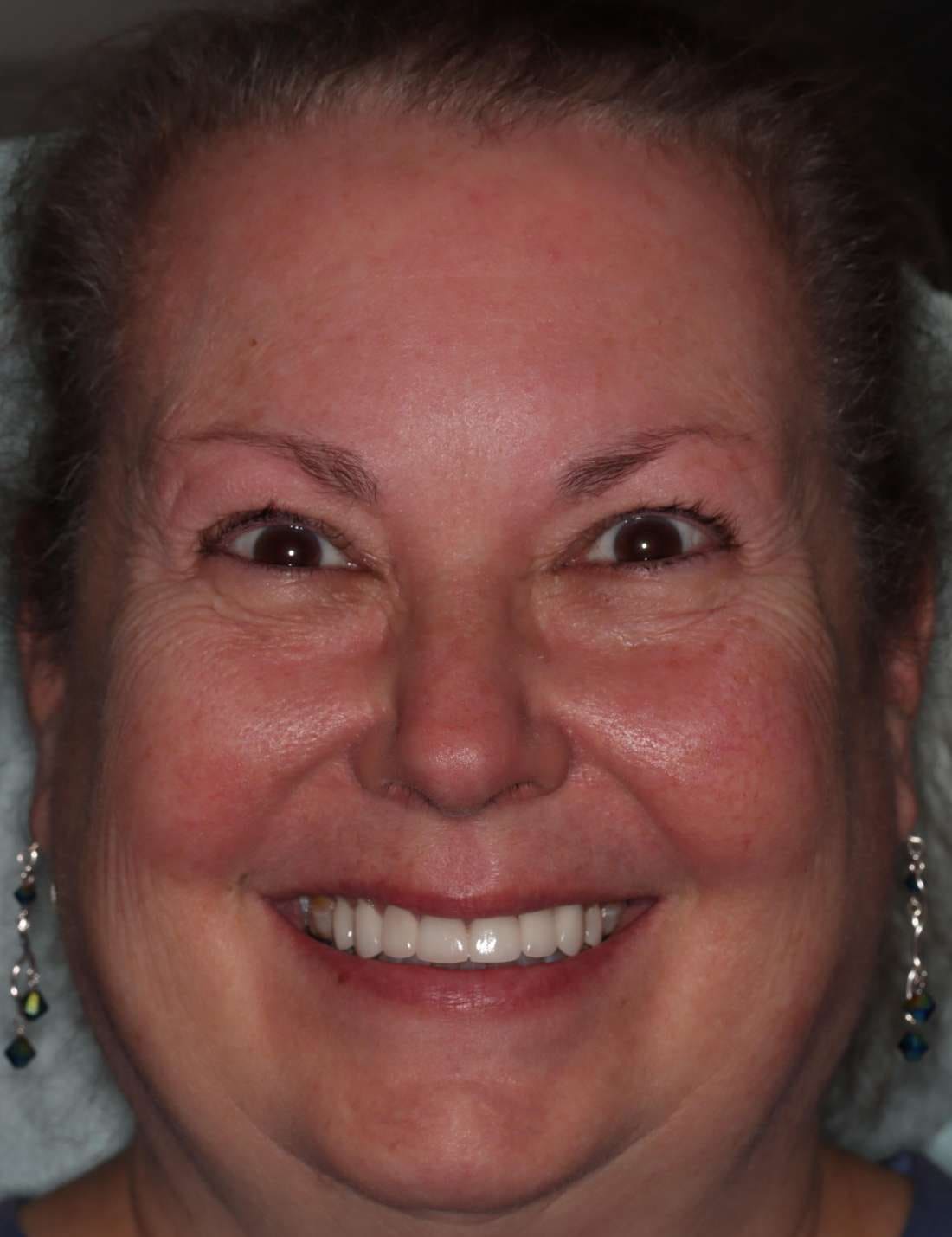 The same patient after her smile makeover, with a full row of even, white teeth