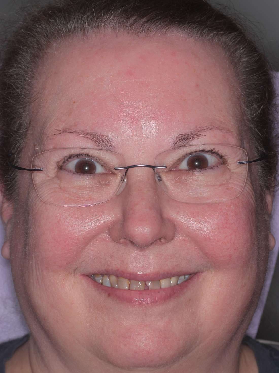 The patient smiling before her makeover, with chipped, worn and discolored teeth