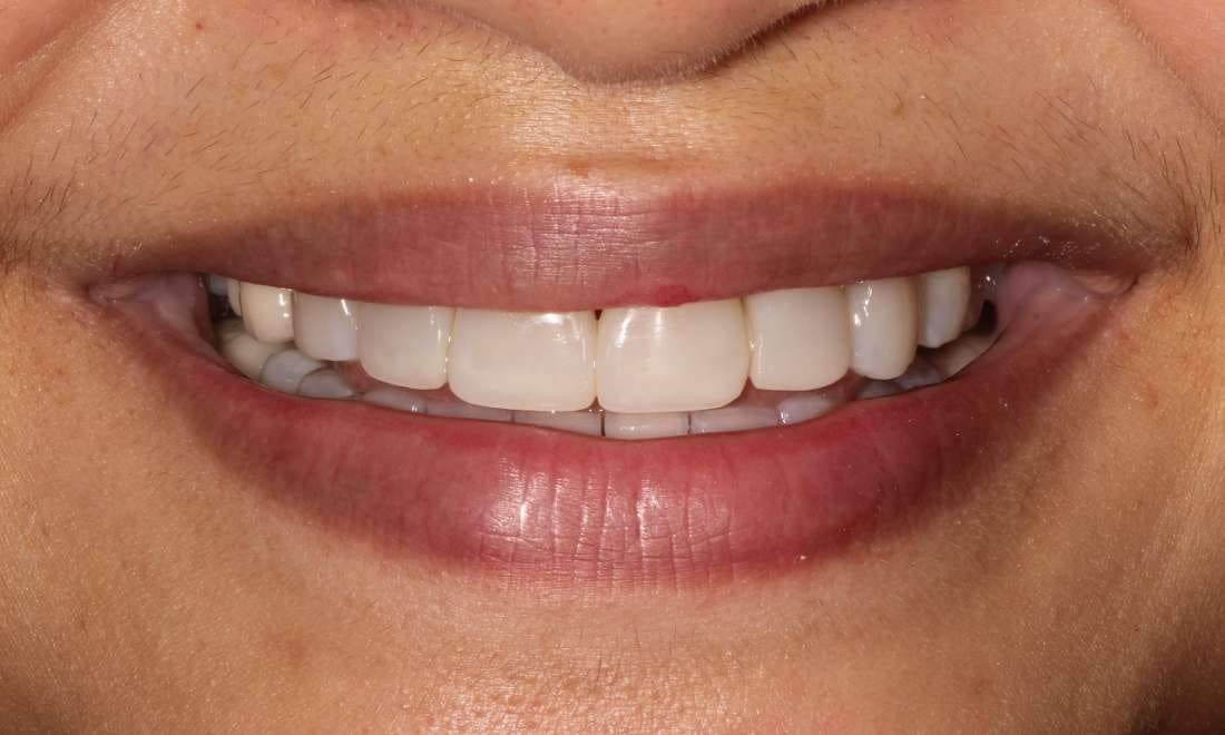 After: the same smile with even, brighter upper front teeth rebuilt with composite veneers