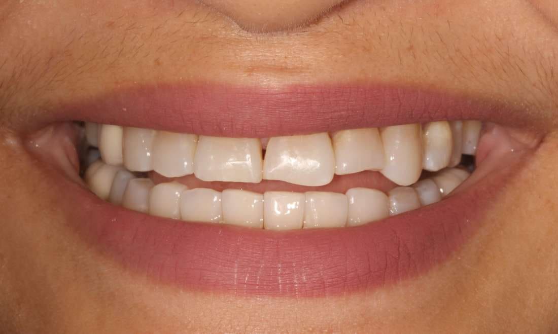 Before: a close-up smile with uneven, worn upper front teeth and a small gap between them