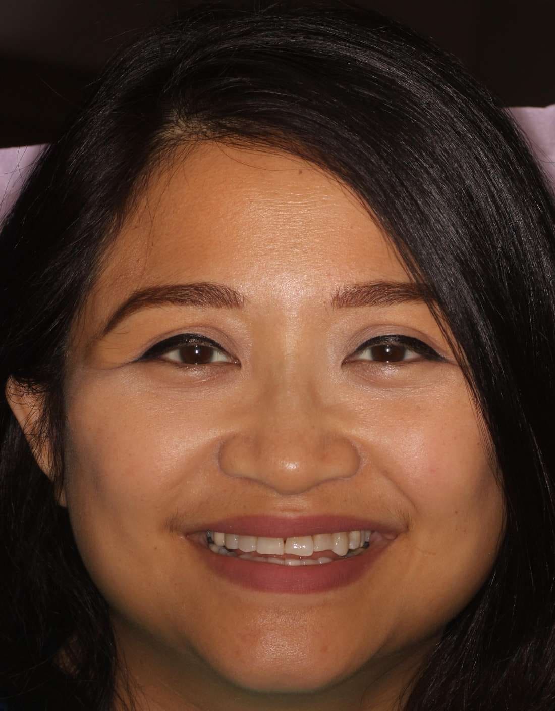 The same patient smiling before treatment, with uneven, worn front teeth